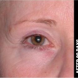 Ultherapy Before & After Patient #1547